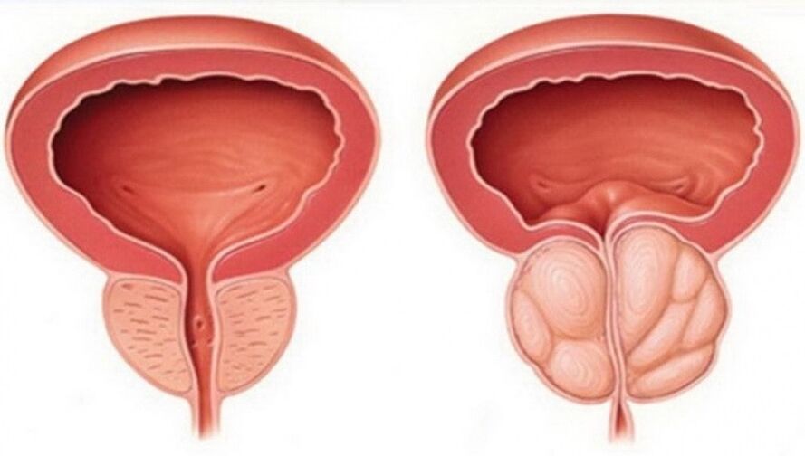 healthy and inflamed prostate with prostatitis