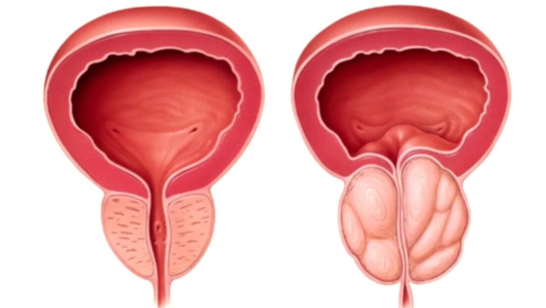 healthy and diseased prostate