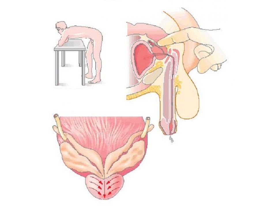 Prostate massage technique by the doctor to take secretion analysis